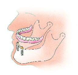 Verankering op implantaten